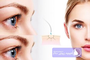 بلفاروپلاستی یا عمل جراحی زیبایی پلک چشم